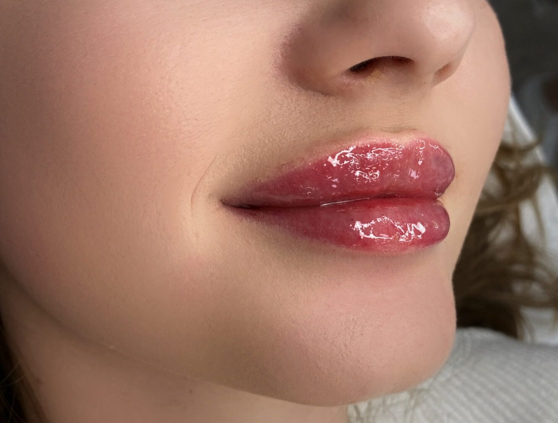 Baby Doll Lips - lips augmentation